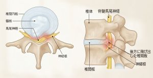 椎間板ヘルニアの説明図
