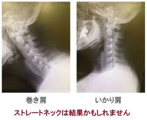 ストレートネックは負担の結果かも