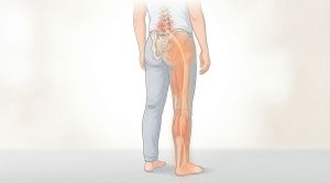 腰から脚にかけて痛みやしびれが出るイメージ