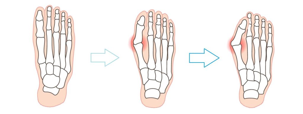 外反母趾の進行の図