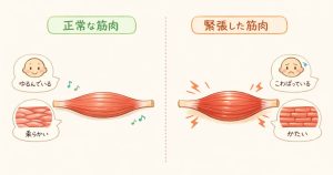 筋肉が縮まり硬くなる図