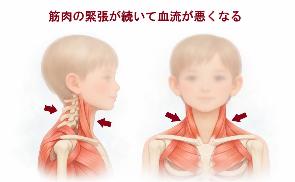 首肩の筋肉の緊張のイラスト