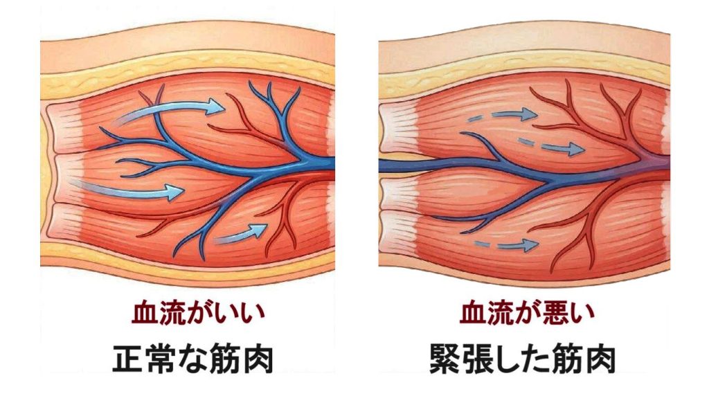正常な筋肉と、筋肉が血管を圧迫して血行不良になるイメージ