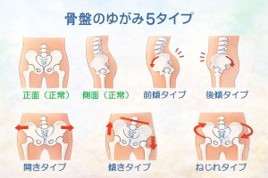 骨盤のゆがみタイプの説明図