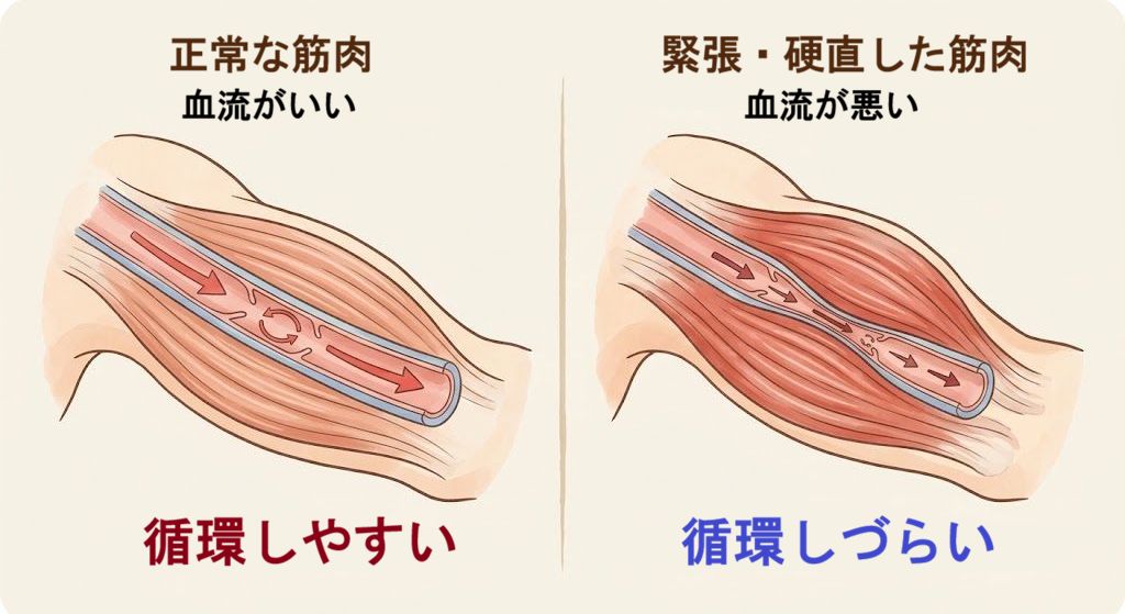正常な筋肉と、筋肉が血管を圧迫して血行不良になるイメージ