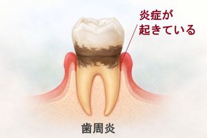 歯周病の炎症イメージ