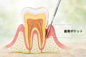 歯周ポケットの説明図