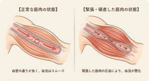 筋肉の正常な状態と緊張状態での血管圧迫イメージ
