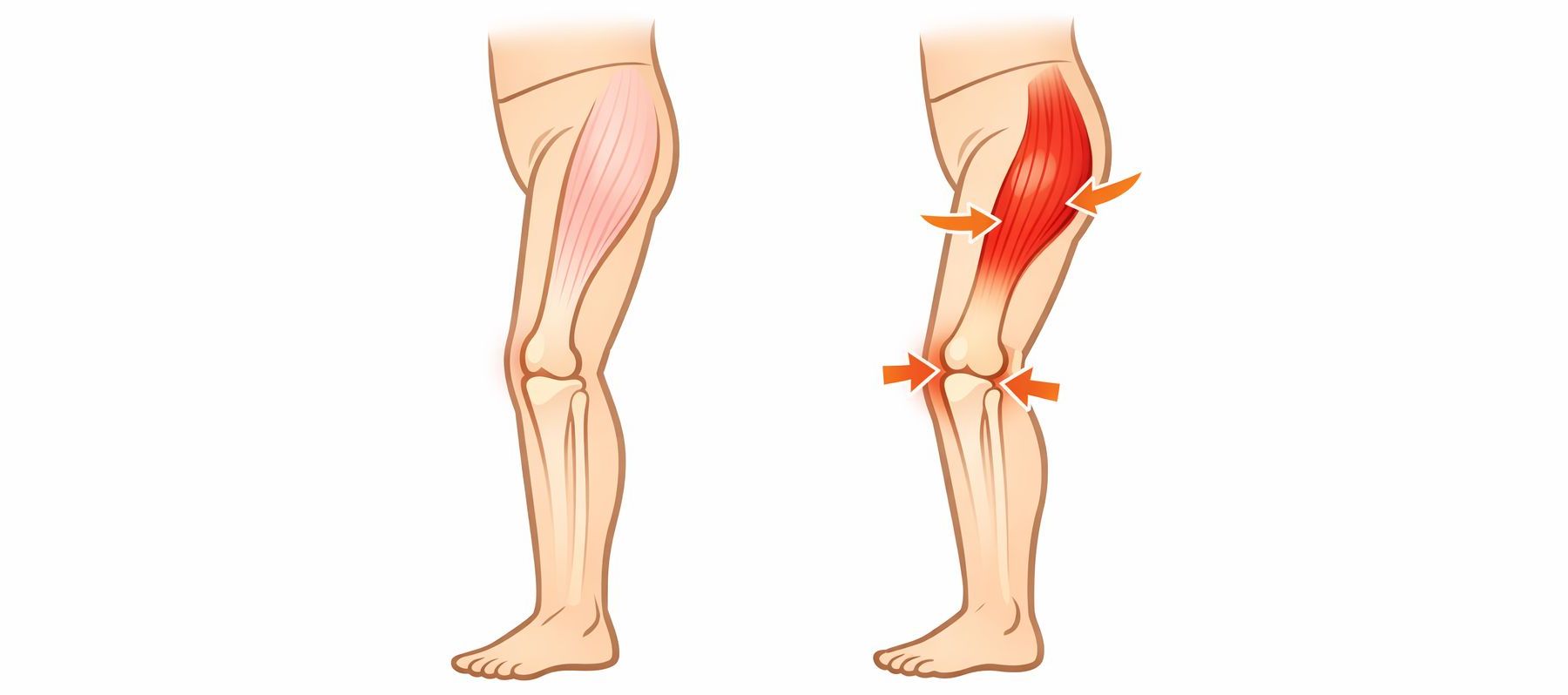 筋肉が硬くなって縮んでいる状態