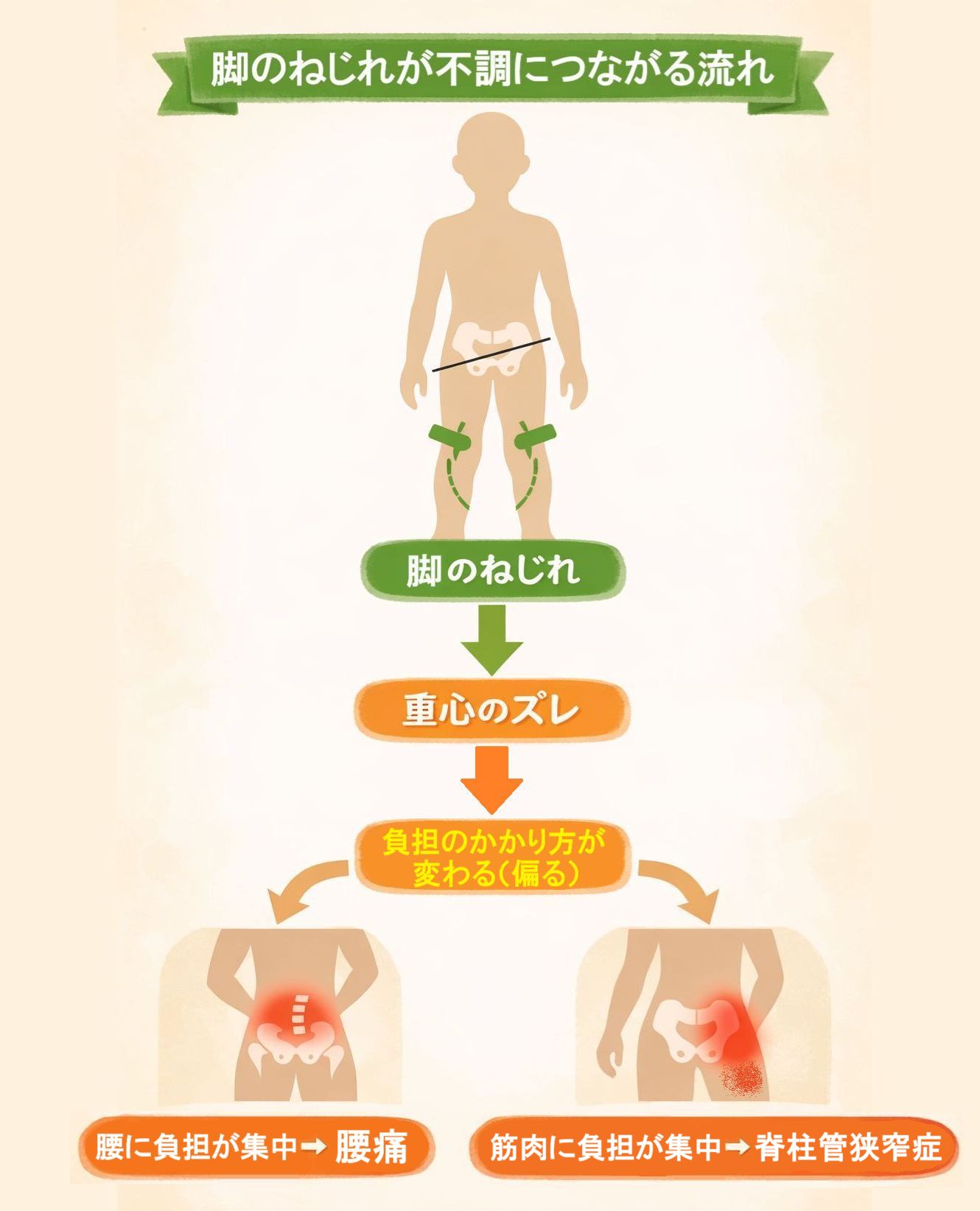「脚のねじれ」→「重心のズレ」→「負担のかかり方が変わる（偏る）」から「腰痛」や「脊柱管狭窄症」が発生する図