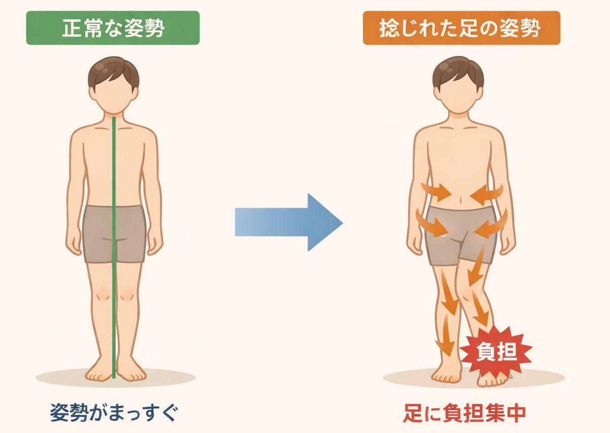 足の痛みにつながる重心のズレ。その前段階の足の捻じれイメージ