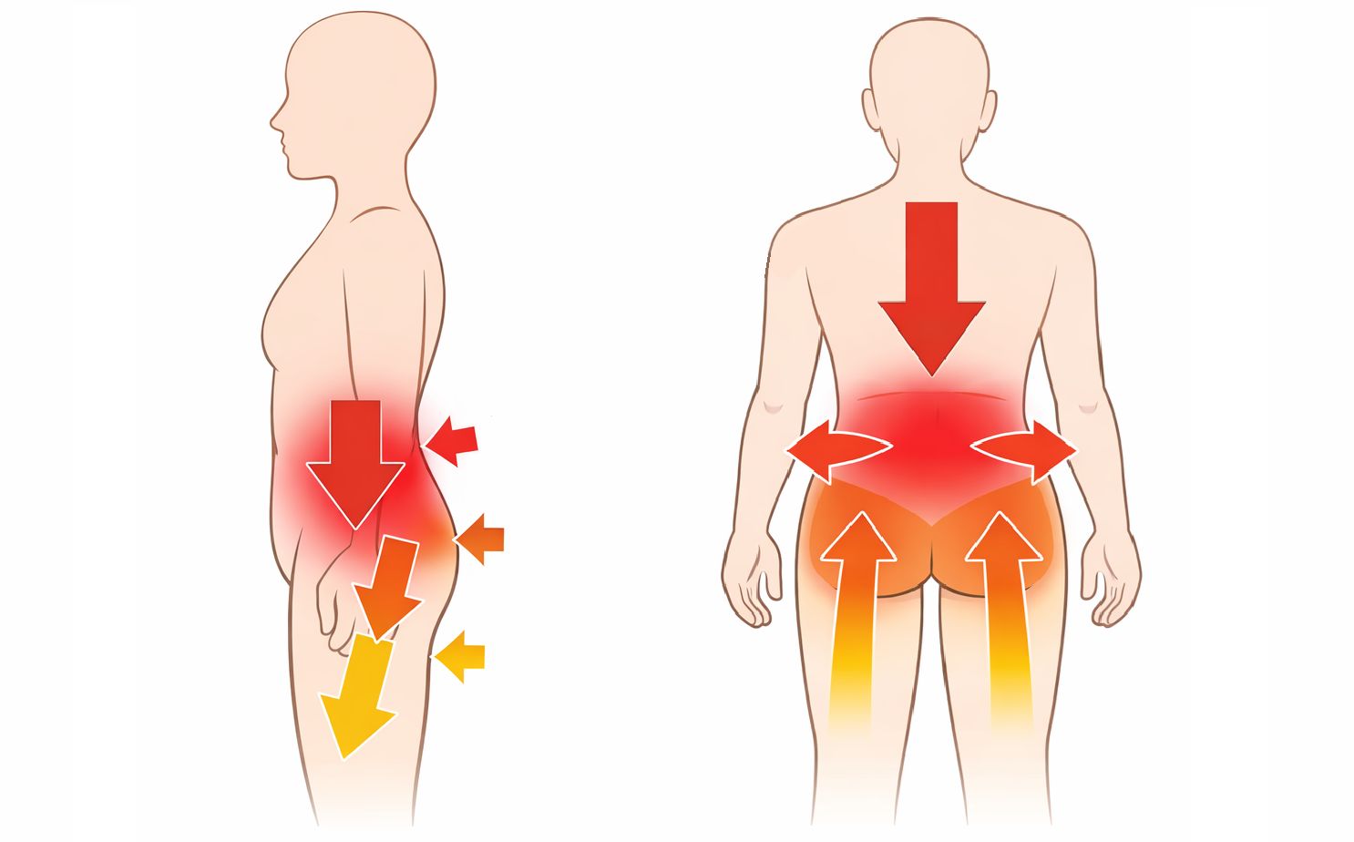 椎間板ヘルニアで腰に負担が掛かっている状態
