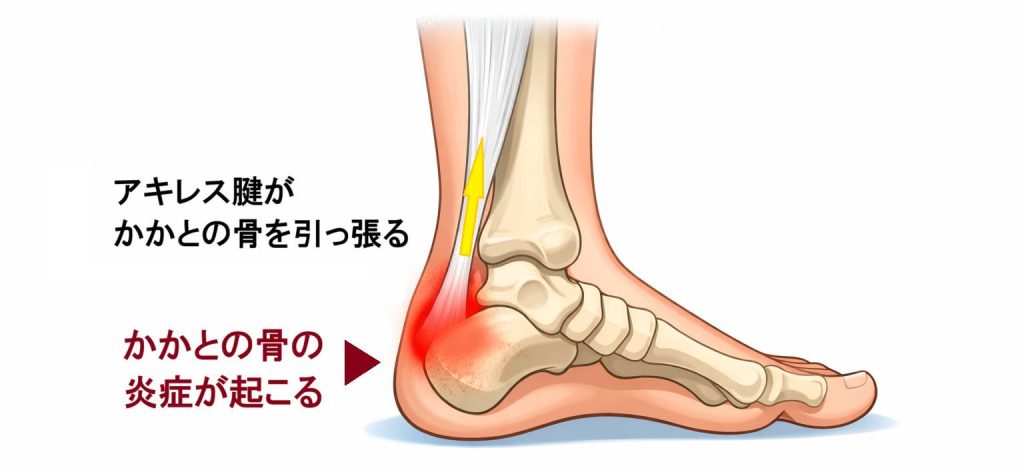 シーバー病のイラスト画像