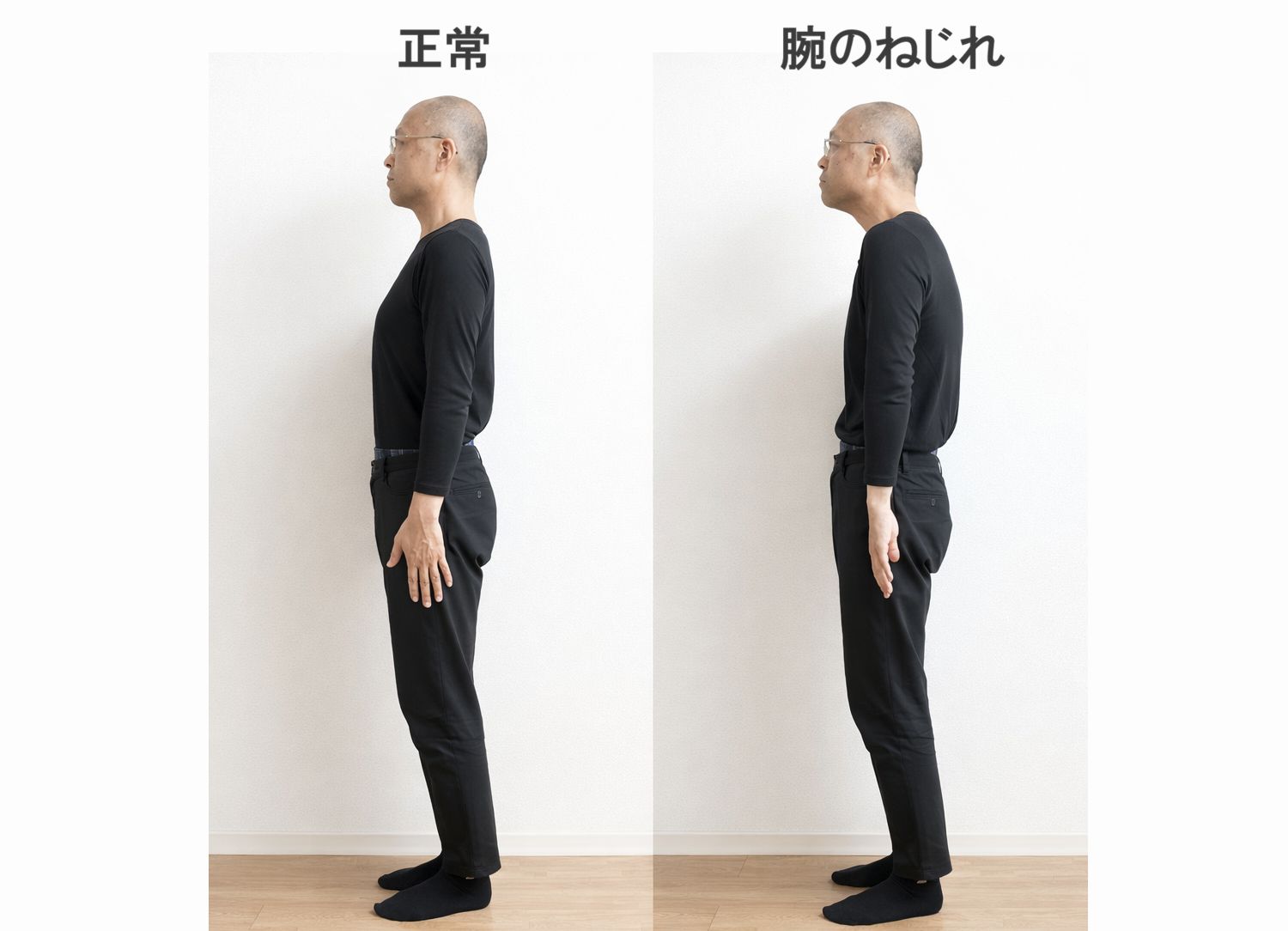 腕のねじれによって肩が前に出て頭部が前方へ出る姿勢の比較